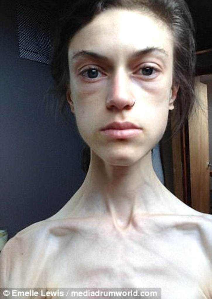 32 kiloya düşən anoreksiya xəstəsi qadın "İnstagram" sayəsində sağaldı - FOTOLAR