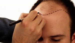 Saç əkilməsi üçün 'robot' inkişaf etdirdi 