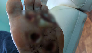 Tutulduğu ət yeyən bakteriya infeksiyası səbəbiylə ayaqlarının altı məhv olan adamın dramı 