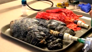 Siqareti tərgidəcək sağlam ciyər və siqaret çəkilən ciyərin müqayisəsi (Video)