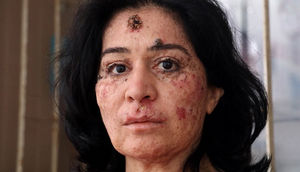 Xəstəliyi səbəbiylə günəşə çıxdıqda orqanlarını bir-bir itirən qadın - FOTO