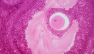 Sonsuzluğun müalicəsində yeni texnologiya