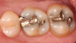 Diş çürüyünü müalicə edəcək 40 qəpiklik üsul - YENİ KƏŞF