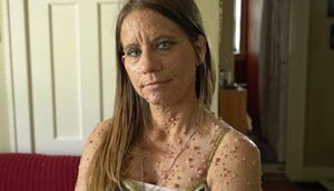 "Qurbağanı" əməliyyat etdilər, gözələ çevrildi - FOTOLAR