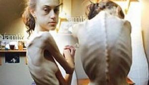 Pəhriz ucbatından ölümlə üz-üzə gələn qızın SON FOTOLARI