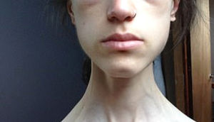 32 kiloya düşən anoreksiya xəstəsi qadın "İnstagram" sayəsində sağaldı - FOTOLAR