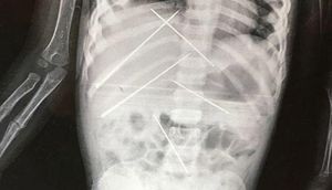 3 yaşlı qızın rentgen kağızı həkimləri dəhşətə gətirdi - FOTOLAR