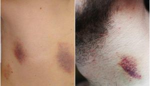 Sevgilisinin dişlədiyi 17 yaşlı gənc öldü - ŞOK