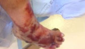 FACİƏ: Ayaqlarını dənizə soxdu, 4 gün sonra qıçı kəsildi - FOTO