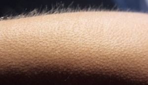 Tüklərimiz hansi səbəbdən "biz-biz" olur? - VİDEO